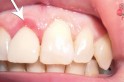 ​Problemas gengivais podem afetar outras partes do corpo se não tratados corretamente, alerta odontologista