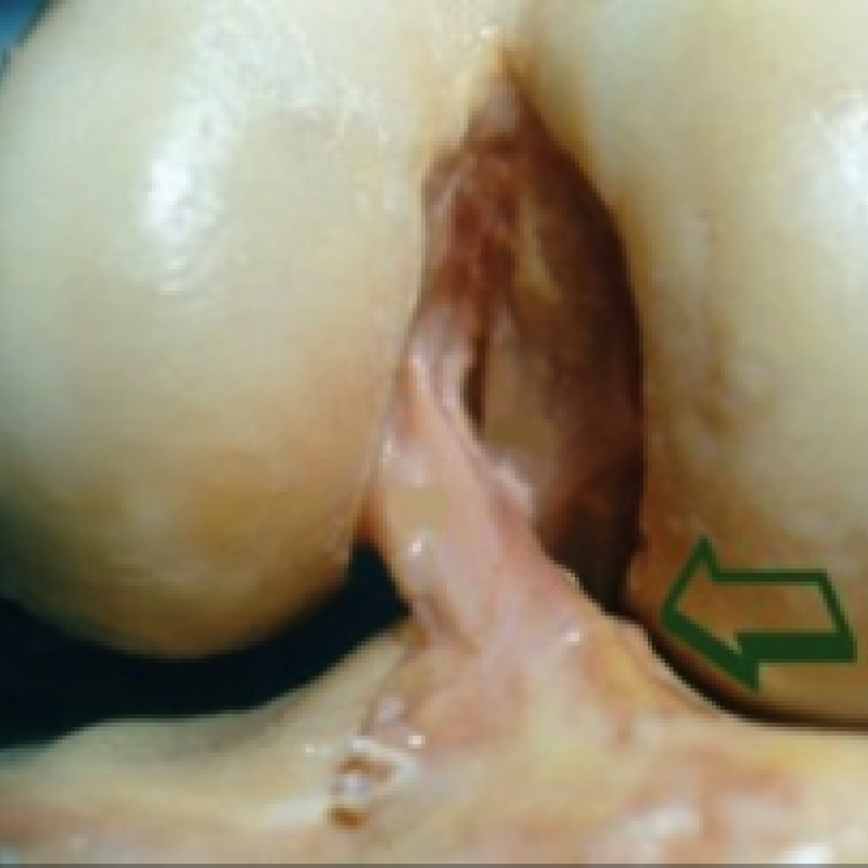 A seta mostra o ligamento cruzado anterior do joelho visto de frente